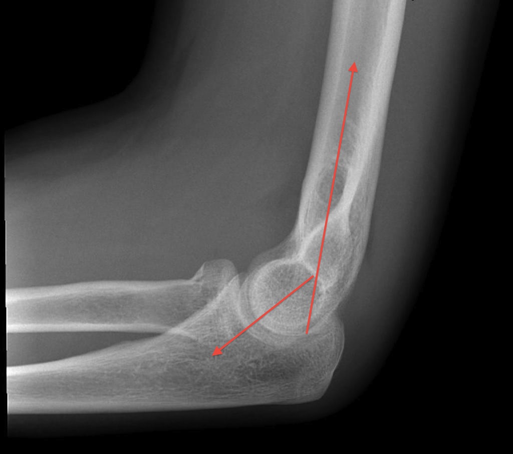 Elbow Lateral Normal 40 degree anterior angulation